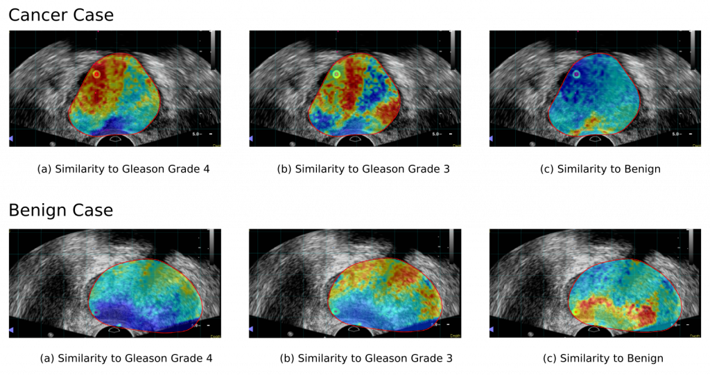 Examples of cancer likelihood maps generated with an unsupervised learning algorithm for cancerous and benign tissues.